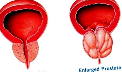 prostata ingrossata catetere