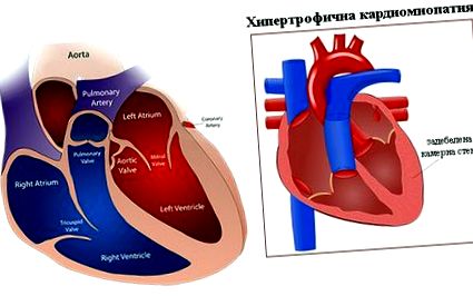 Cardiomiopatia hipertrofică