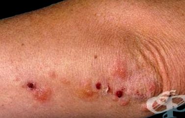 Dermatita herpetiformă