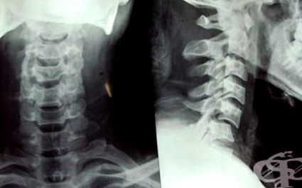dislocarea vertebrei cervicale