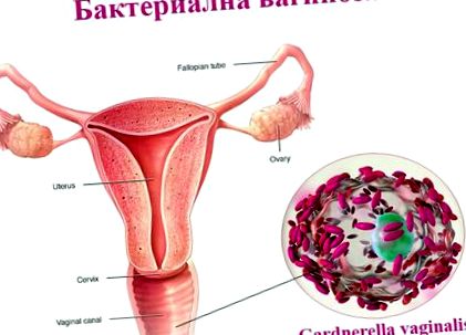 vaginoza bacteriană