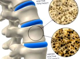 osteoporozei