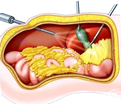 sindrom postcolecistectomie