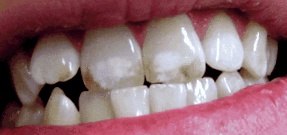 dinții