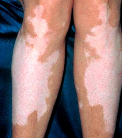 vitiligo kezelésére