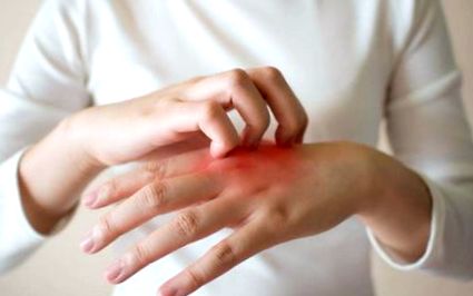 Eczema mâinilor