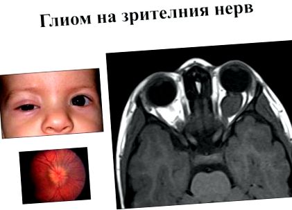 scăderea acuității vizuale a nervului optic)