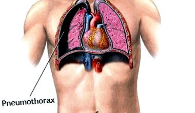 colapsul pulmonar