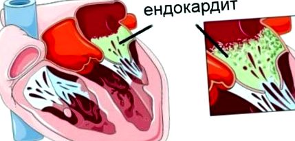endocardită