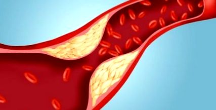 étrendi koleszterin és a szív egészsége magas vérnyomásból származó atheroclephitis
