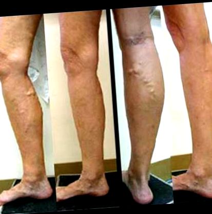 cum de a vindeca picioarele varicoase