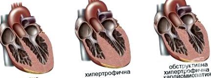 ventriculul stâng