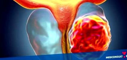 prostata rosszindulatú daganata mi okozza a prosztatitist