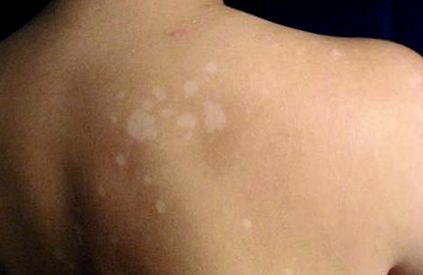 tinea versicolor