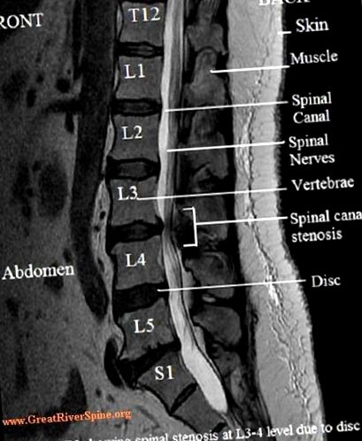 stenosis