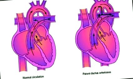 arteriosus