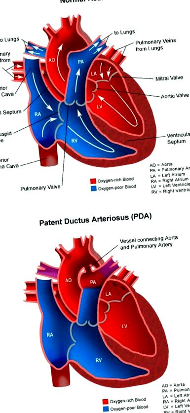 arteriosus