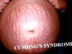 pierderea în greutate sindromul cushing