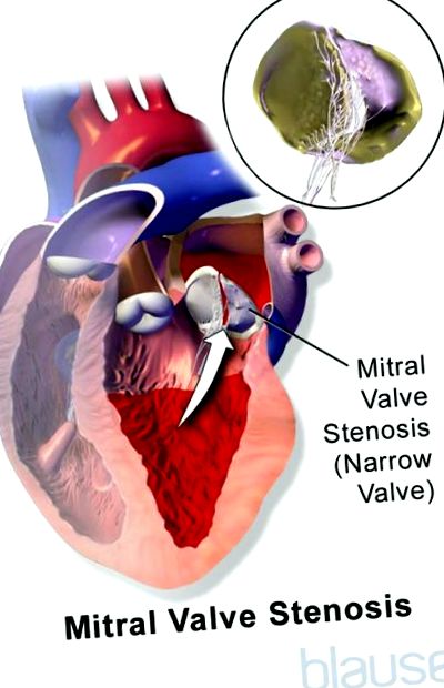 mitrală