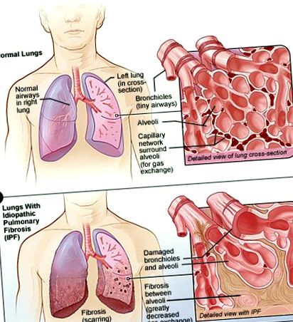 pulmonară