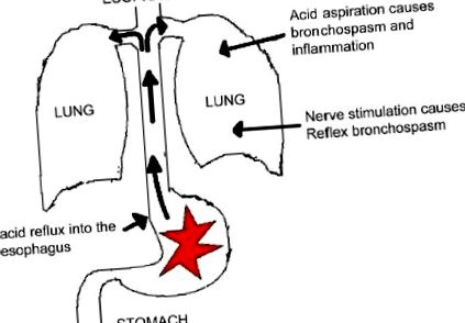 reflux