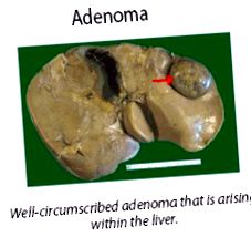 adenoamele