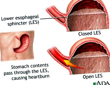 gastroesophagealis