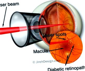 ретината