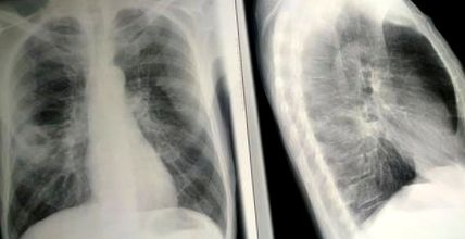 pulmonar-etiologie