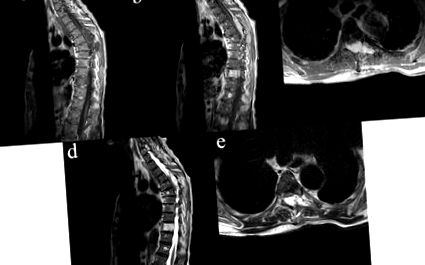 vertebral