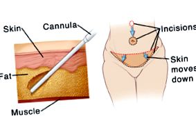 abdominoplastie