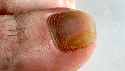 nail gombák savas kezelés