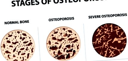 остеопорозата