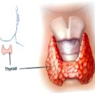 hipotiroidism