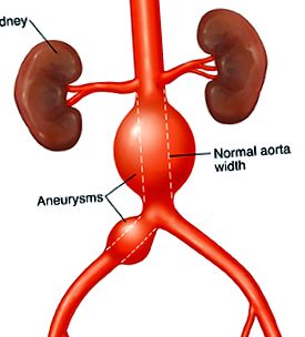 aortic abdominal