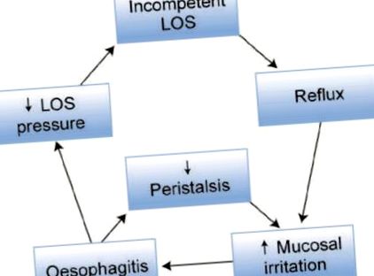 gastro-esofagian