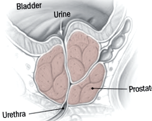 Exacerbations a prostatitis