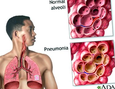 пневмонии