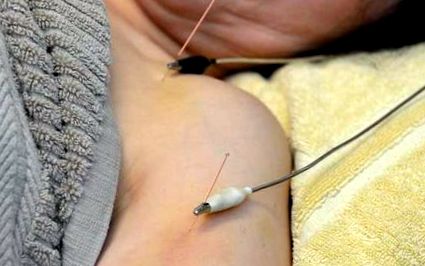 electroacupunctura