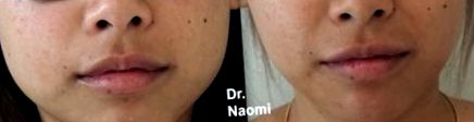 arc karcsúsító injekciók sydney zsírvesztés mértéke