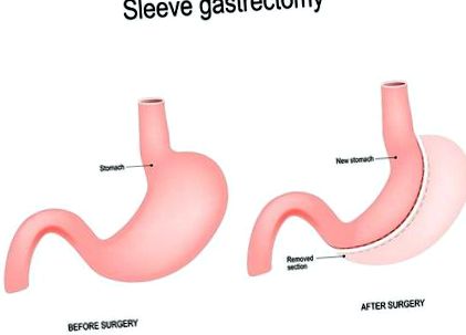 gastric