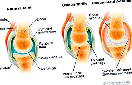 Osteoartrita este