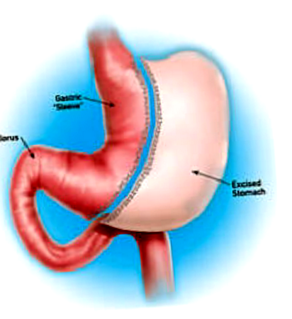 bariatric