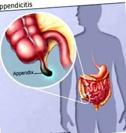 apendicita