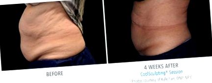 coolsculpting