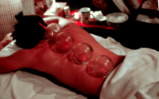 cupping