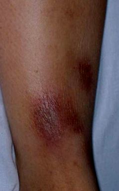 erythema