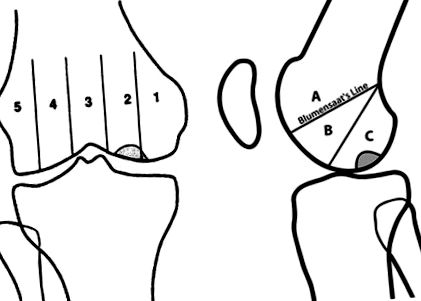 osteocondrita