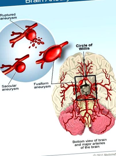 Anevrism cerebral Semne timpurii, simptome, cauze și rata de supraviețuire