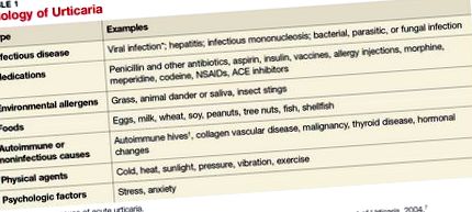 urticaria